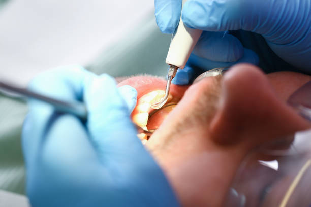 Best Emergency Wisdom Teeth Removal in South Cleveland, TN